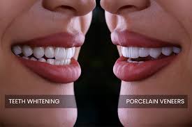 Dental Veneers Clinic in Dubai Marina: What Should You Know Before Getting Veneers?
