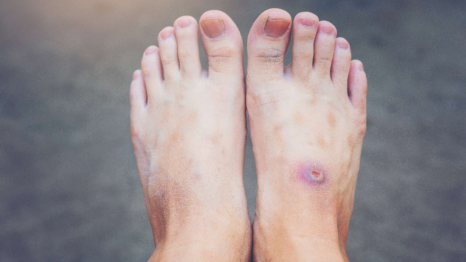 Venous Ulcers vs. Arterial Ulcers: Key Differences to Know