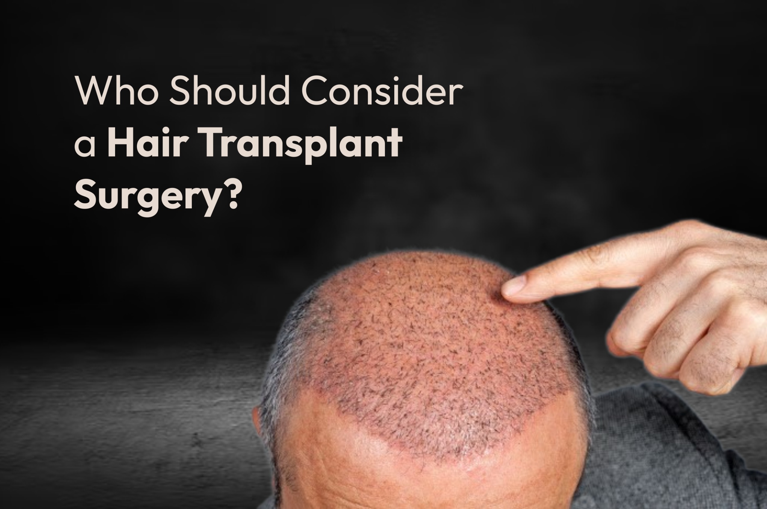 Who Should Consider a Hair Transplant Surgery?
