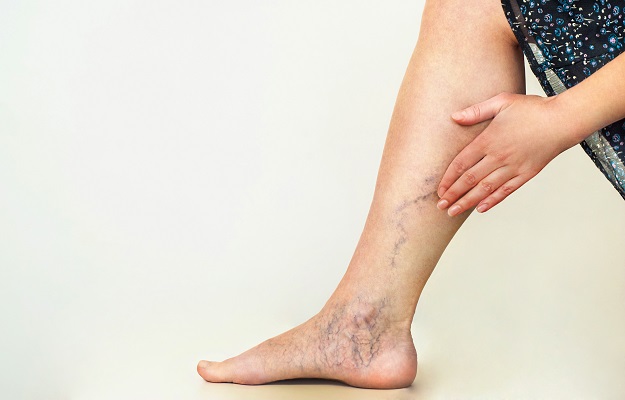 How Family History Influences Your Risk of Varicose Veins