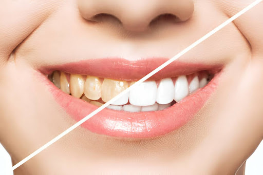 Benefits of Choosing a Dentist for Teeth Whitening in Aberdeen?