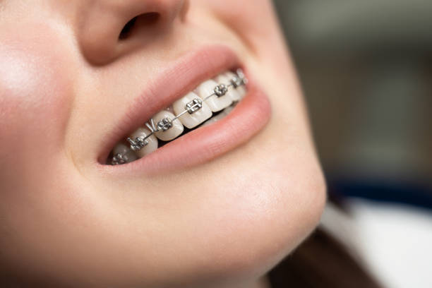 Early Orthodontic Treatment with Teeth Braces in Islamabad Pakistan Matters