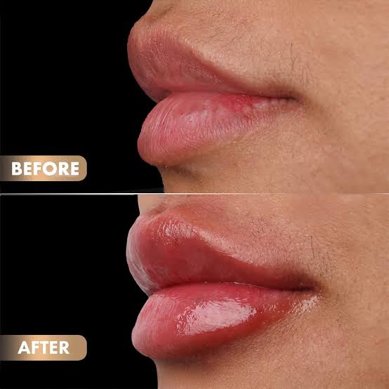 Lip Fillers in Dubai: What to Know Before Your Treatment