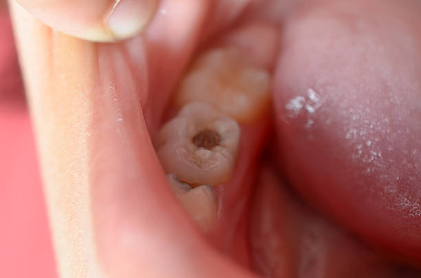 Effective Solutions for Repairing Damaged Teeth Tooth Fracture Treatment in Pakistan: