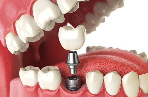 Why Is the Best Dental Implants in Dubai Higher Than in Other Emirates?