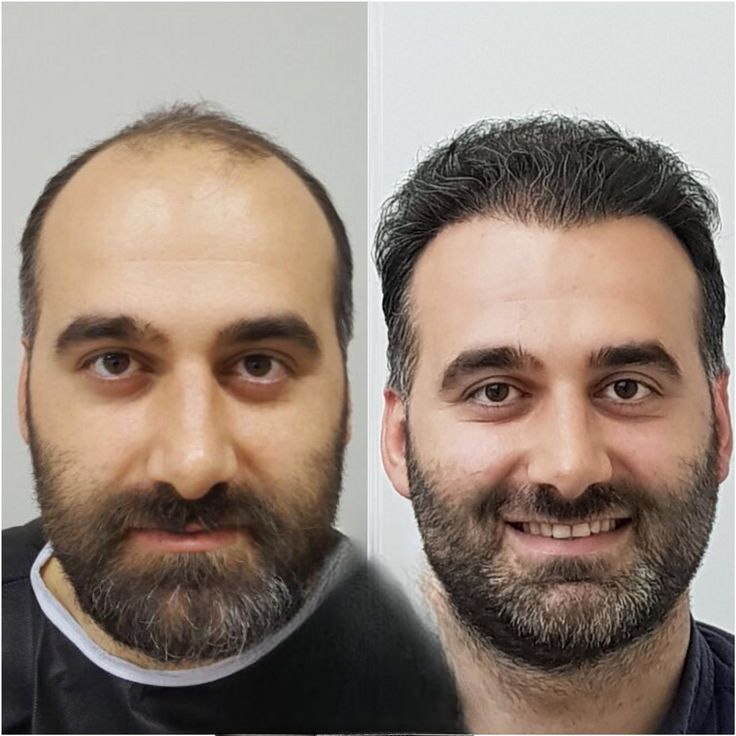 Hair Transplant in Islamabad 