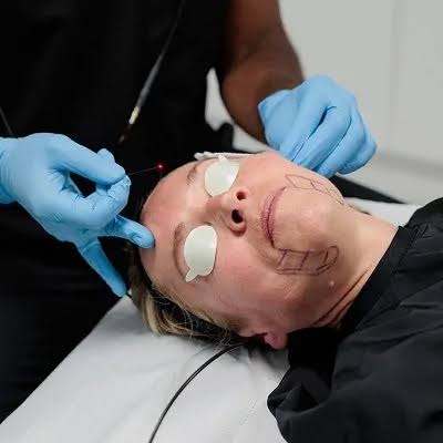 Endolift Procedure in Dubai: Understanding the Treatment