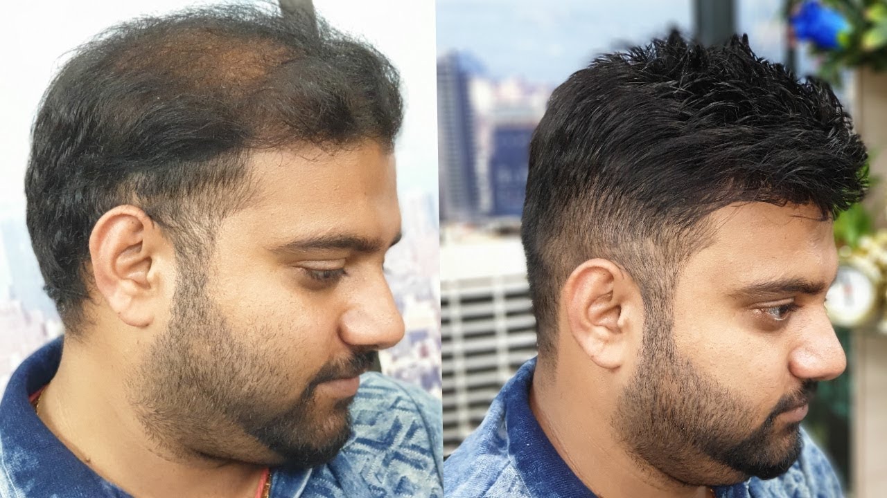 Decoding Excellence: A Deep Dive into the Best Hair Transplant in Pakistan