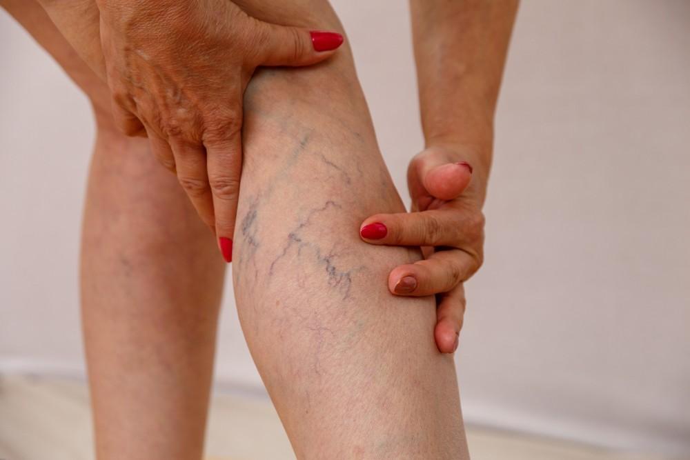 Can Varicose Veins Affect Your Daily Activities and Mobility?