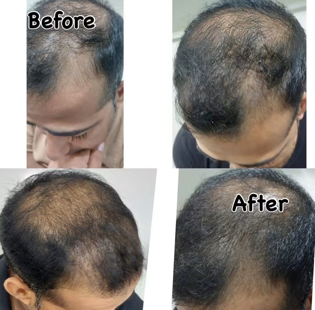 How Does Hair Replacement Work? A Complete Guide?