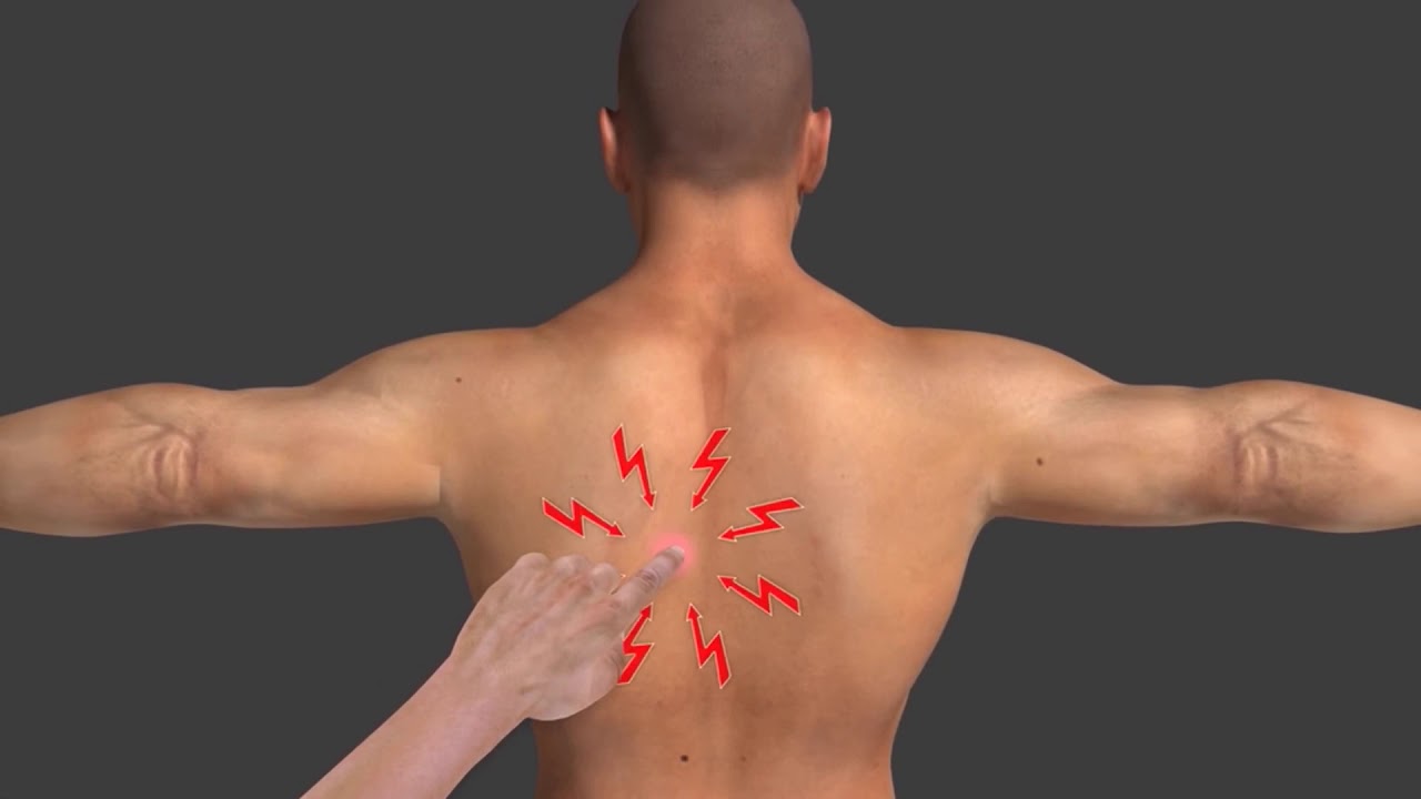 How Often Can You Get Trigger Point Injections? What You Should Know