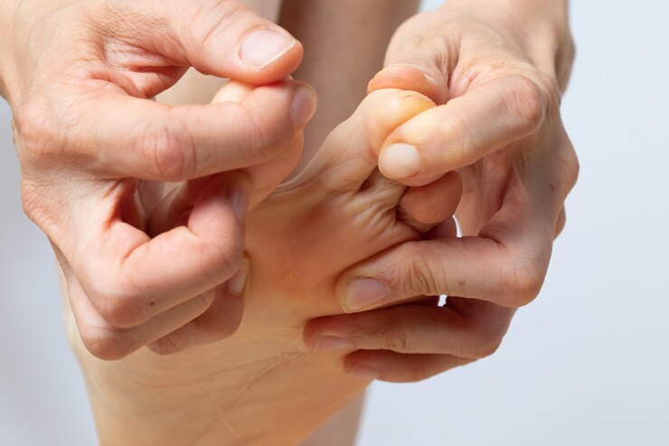 How Does a Doctor Surgically Remove a Wart?
