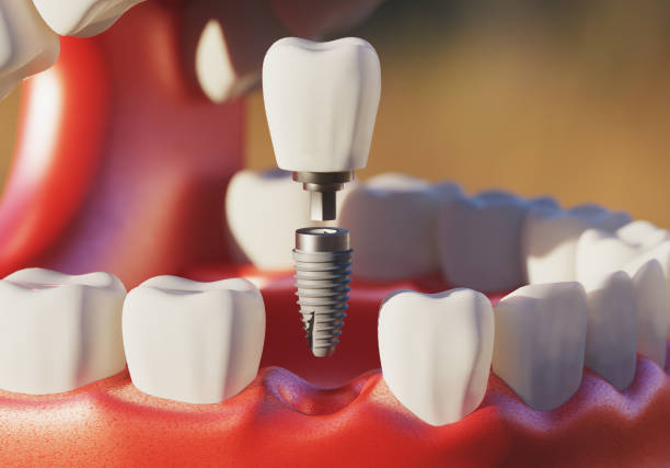 Preserve Your Natural Tooth with Modern Dental Solutions Root Canal Treatment :