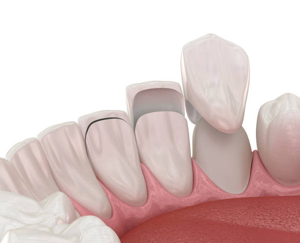 Most Asked Questions Patients Search on Google Dental Veneers in Islamabad Pakistan: