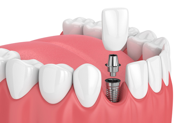 Top 5 Benefits of Dental Implant Treatment!