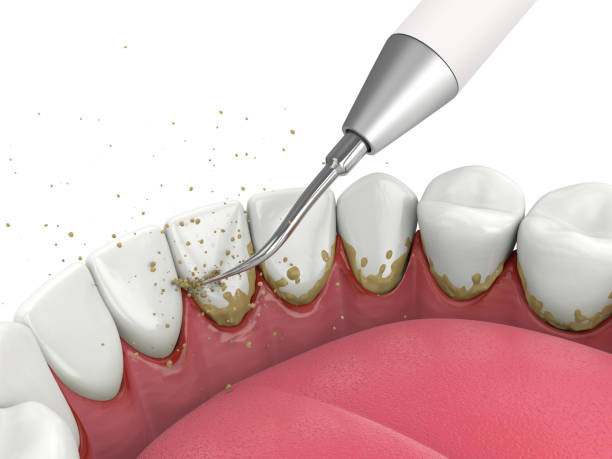 How Teeth Scaling and Polishing Contribute to Better Oral Health and Confidence
