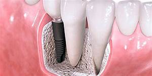 Top 10 Destinations for Affordable Dental Implants Abroad